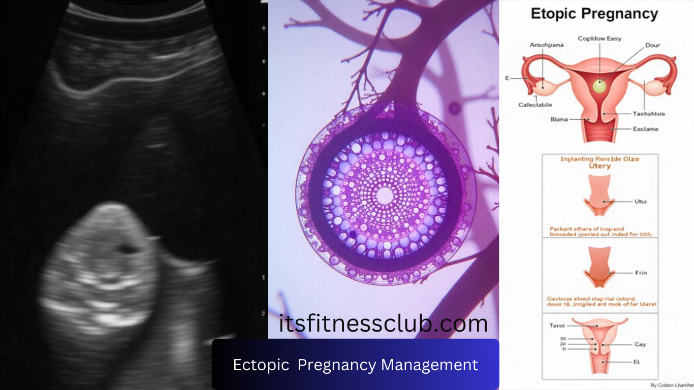 Ectopic Pregnancy